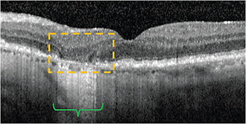 GA is considered a subset of cRORA, though it is characterized by more extensive features, such as photoreceptor degradation, shown here. Image courtesy of Dr. Nijm and Dr. Mary Beth Yackey.