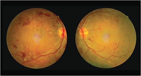 Bilateral, severe diabetic retinopathy in a type 2 diabetes patient.Image courtesy of Dr. Reynolds