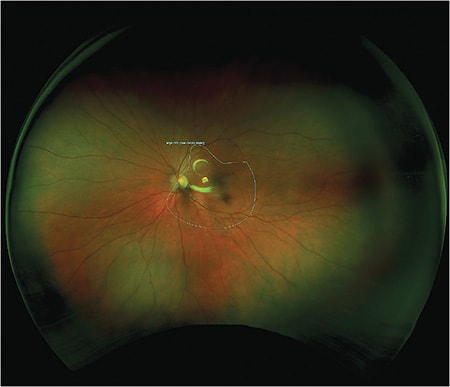 At Dr. Earley’s practice, he’s found patients are often more engaged with their eye health when they can see an image of their eye.Image courtesy Dr. Timothy Earley.