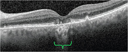 HyperTDs are visible as bright regions, resulting from increased light passing through the choroid. Image courtesy of Dr. Nijm and Dr. Mary Beth Yackey.