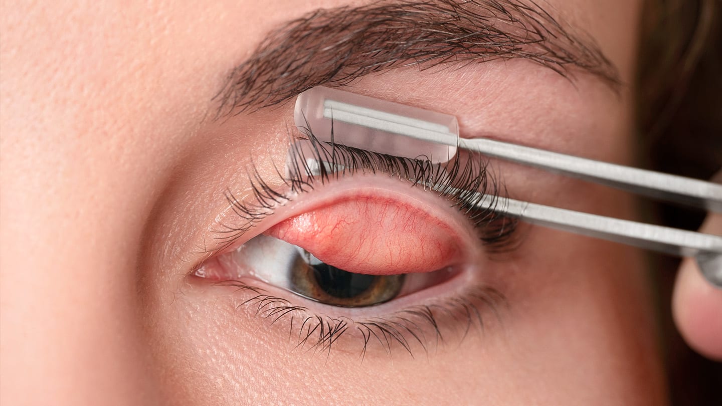 Everting the lid can provide a clear view of the structures for assessment. (Photo courtesy: Dr. Brujic)