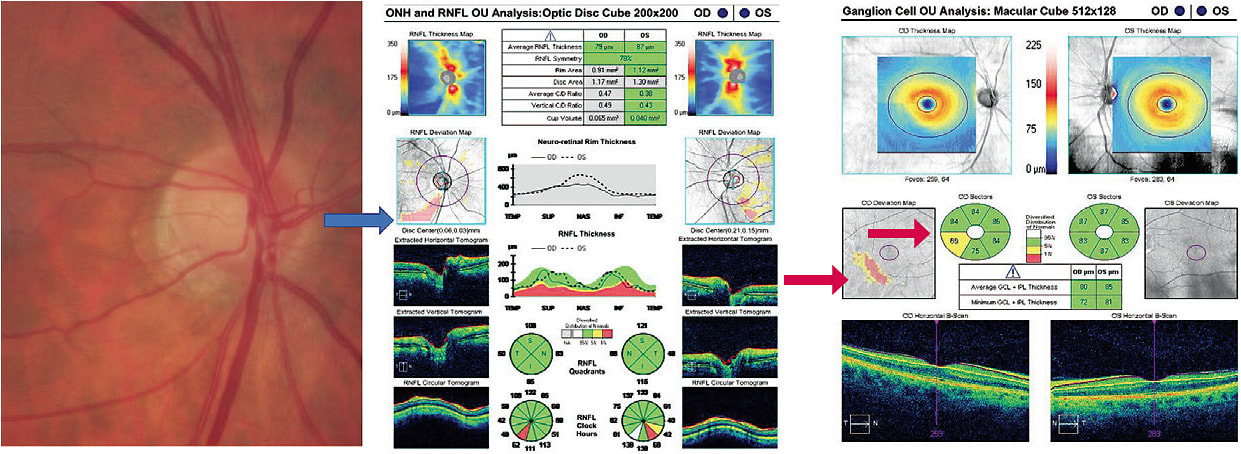 Figure 2. Left: CFP. Note the small optic disc size and inferior temporal vessel deflection illustrating a thin inferior rim. Center: RNFL analysis of right eye showing statistical RNFL thinning (blue arrow). Right: Note the statistical and absolute thinning of the inner retina (red arrows).