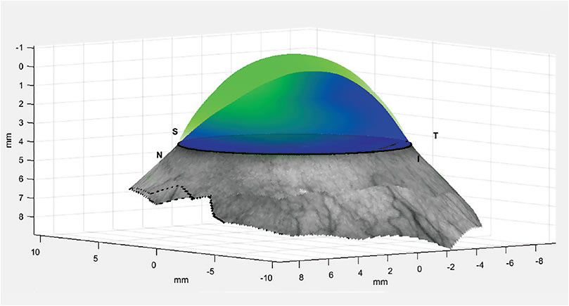 Corneo-scleral topography showing asymmetric vault in a pellucid marginal degeneration patient. 
Image courtesy of Dr. Greg DeNaeyer, O.D.