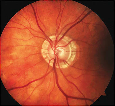 Average to large nerve with inferior temporal thinning and associated glaucomatous disc hemorrhage with diffuse RNFL pattern loss and parapapillary atrophy.Image courtesy of Dr. Austin Lifferth.