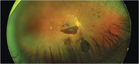 Widefield SLO image of proliferative DR with multiple pre-retinal hemorrhages, intraretinal dot and blot hemorrhages and superior/inferior scars from previous pan-retinal photocoagulation treatment. Optos images courtesy of Hannah Calvelli, O.D.