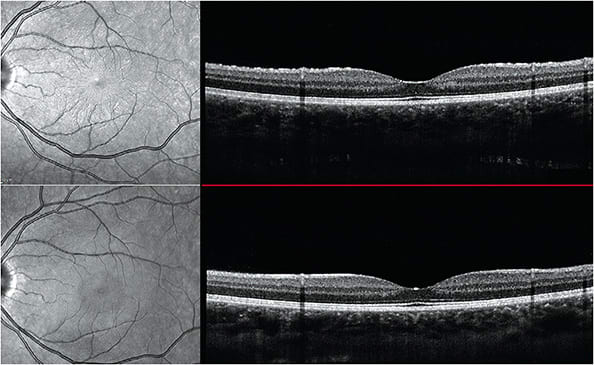 Figure 4. Top image shows subtle retinal striae on infrared reflectance image (left) and on the retinal surface (right). The patient had a myopic shift at the time. Bottom image shows resolution of striae post discontinuation of topiramate. The myopic shift also resolved. Image courtesy of Dr. Jessica Haynes.