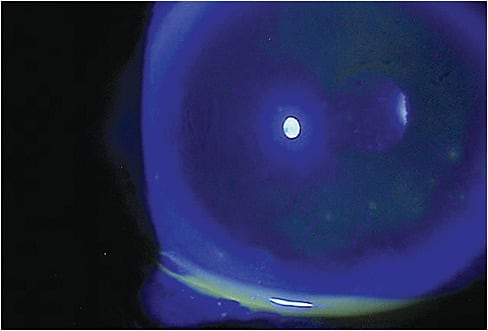 Note: the healing of RCE in this EBMD patient.
Courtesy of Savannah Brunt, O.D.