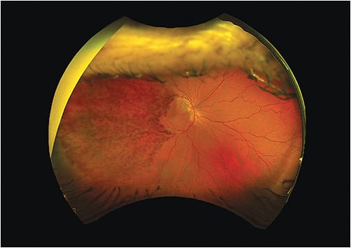 An image of a branch retinal vein occlusion (BRVO) with macula edema, showing blockage in the vein. This blockage can be caused by thickening of the arteries caused by a buildup of plaque. Regarding dietary advice, Dr. Wademan would suggest this patient eats a healthier diet that includes brightly colored vegetables and omega-3s.Photo courtesy of Dr. Wademan.