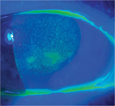 Dry eye disease as seen in a patient who has diabetic retinopathy.Image courtesy of Dr. Cecelia Koetting.