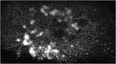 On FA, several active patches of active neovascularization, indicating the need for treatment of proliferative disease.