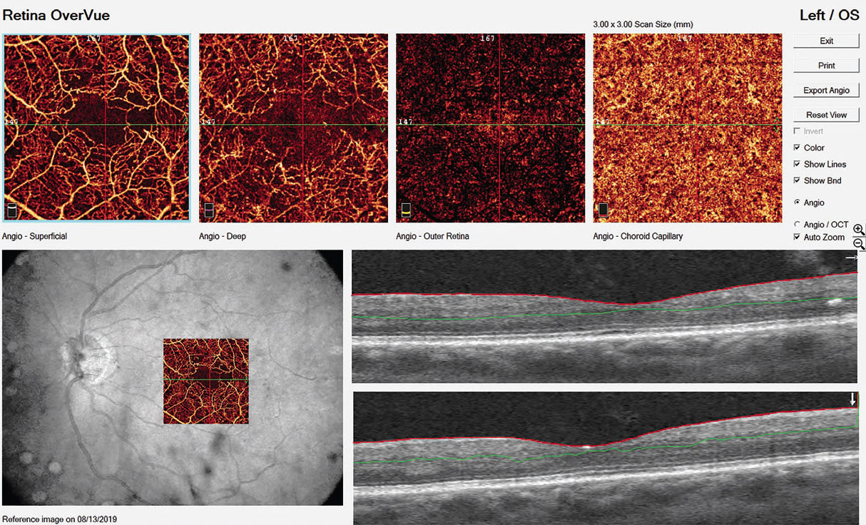 OCT and OCT-A scans showing mild nonproliferative diabetic retinopathy and capillary non-perfusion, secondary to diabetes.