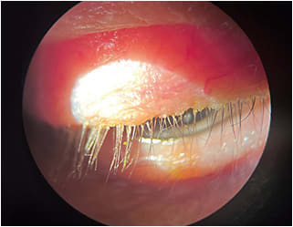 Upon slit lamp view, collarettes can be seen in this patient who has Demodex blepharitis.Image courtesy of Dr. Koetting