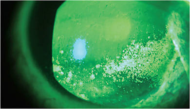 Dense PEE/SPK seen in a patient with DED, ocular rosacea, and Demodex blepharitis.