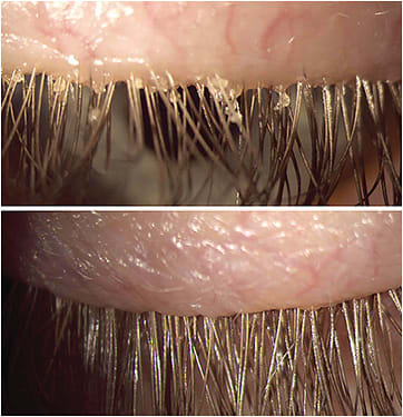 Figure 3. Microblepharoexfoliation cleans accumulated bacterial biofilms from the eyelid and lash margins manually or mechanically (a motorized brush, like an electric toothbrush), resulting in improved DED symptoms and signs.Figure 3 courtesy of Dr. Madan.