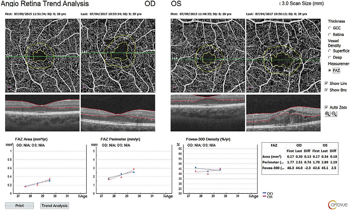 The AngioRetina FAZ Trend Report displays foveal avascular zone parameters of both eyes over time to aid in the assessment of symmetry and longitudinal change.