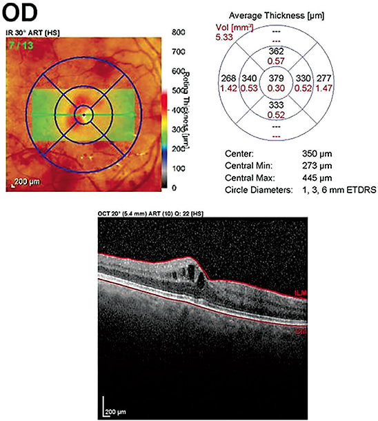 OCT quantification of the central thickness of the macula. Images courtesy of Dr. Jacqueline Theis.