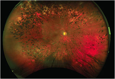 Proliferative diabetic retinopathy after pan-retinal photocoagulation. All images courtesy of Dr. Chris Wroten.