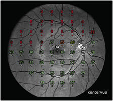 IMAGE: 24-2 perimetry pattern registered to exact retinal location.