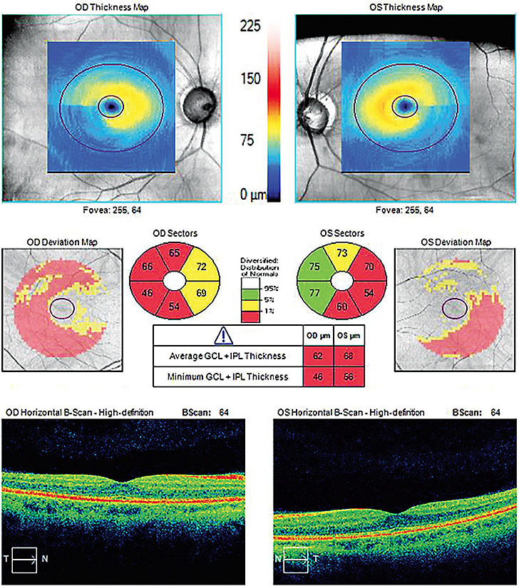 Note the ONH and RNFL analysis, OU, via OCT, of this glaucoma patient.
Images courtesy of Austin Lifferth, O.D., F.A.A.O.