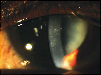 Pigmented keratic precipitates indicate a chronic, or recurrent uveitis.