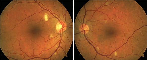 Figure 5. Cotton wool spots and retinal hemorrhages in interferon retinopathy. Image courtesy of Dr. Jessica Haynes.