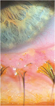 Toothpaste-like consistency meibum is shown above in a patient who has meibomian gland disease.