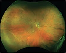 IMAGE: Diabetic retinopathy with predominantly peripheral lesions.