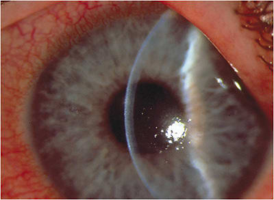 Acanthamoeba keratitis at one month, with stromal edema and inflammatory cells. Symptoms included severe pain.Image courtesy of Dr. Susan Gromacki.