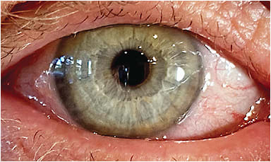 Figure 4. Patients with ocular rosacea can be treated in clinic with intense pulsed light therapy.Photo courtesy of Dr. Melissa Barnett and Dr. Lisa Hornick.