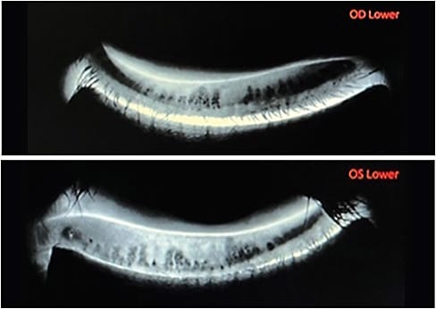 Note the significant meibomian gland atrophy in this pre-fitting evaluation of a patient.Photo courtesy of Dr. Susan A. Resnick.