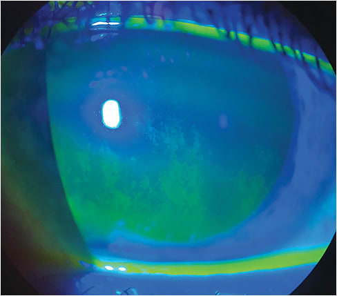 DED can lead to permanent vision loss if left untreated.Photo courtesy of Dr. Jade Coats.