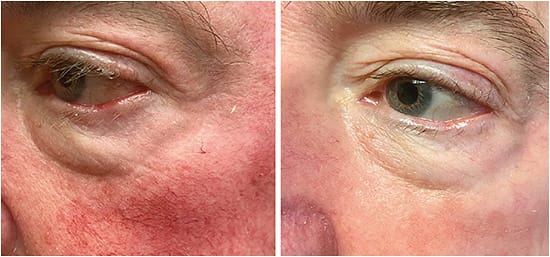 Figure 2. Intense pulsed light is an ideal treatment for patients who have rosacea-related ocular surface disease because the treatment uses specific wavelengths of light to help diminish telangiectatic blood vessels over time.Figure 2 courtesy of Dr. Madan.