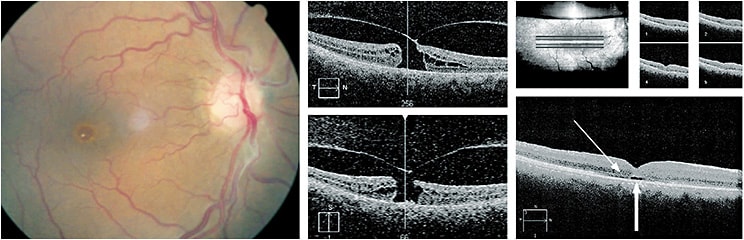 Figure 4. Left: CFP showing small FTMH. Center: horizontal and vertical cross-sections through the macula. Note the cystic spaces within the retina and relationship to the vitreous. Right: One-week post-op cross-section showing intact external limiting membrane (fine arrow), but absent photoreceptor layer (bold arrow). Images originally appeared in Optometry Times, March 2019.