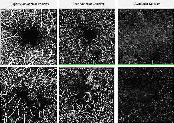 OCT-A presentation of two patients who have NPDR.