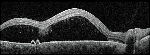 Figure 2. Acute CSCR with large serous detachment and pigment epithelial detachments induced by steroid injection for shoulder pain. Image courtesy of Dr. Jessica Haynes.