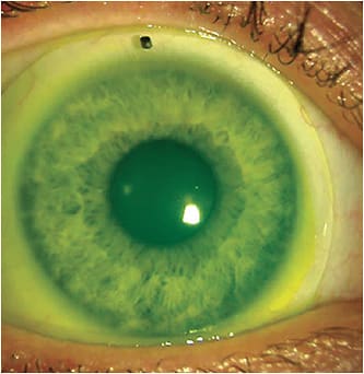 A scleral lens fit on an eye that has keratoconus. Image courtesy of Dr. Susan Resnick.