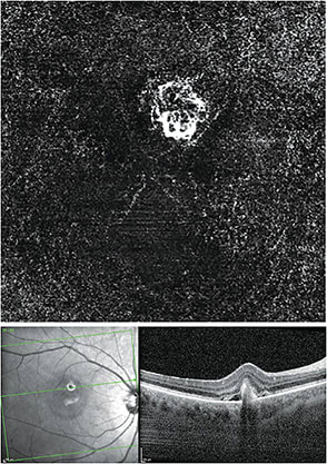 Note the choroidal neovascular membrane (top) and the small elevated retinal lesion (bottom).