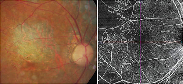 SD-OCT shows diabetic retinopathy with diabetic macular ischemia, with paramacular areas of capillary nonperfusion and atrophy of the RPE. Images are courtesy of Dr. Sherrol Reynolds.