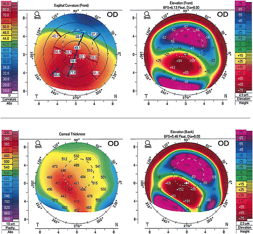 Corneal surface imaging is important to perform prior to scleral lens fit to visualize the corneal shape and its potential limitations. Corneal topography provides a topographical map of the anterior corneal surface, and corneal tomography provides maps of the anterior and posterior corneal surfaces.
Images are courtesy of Dr. Micaela Crowley.