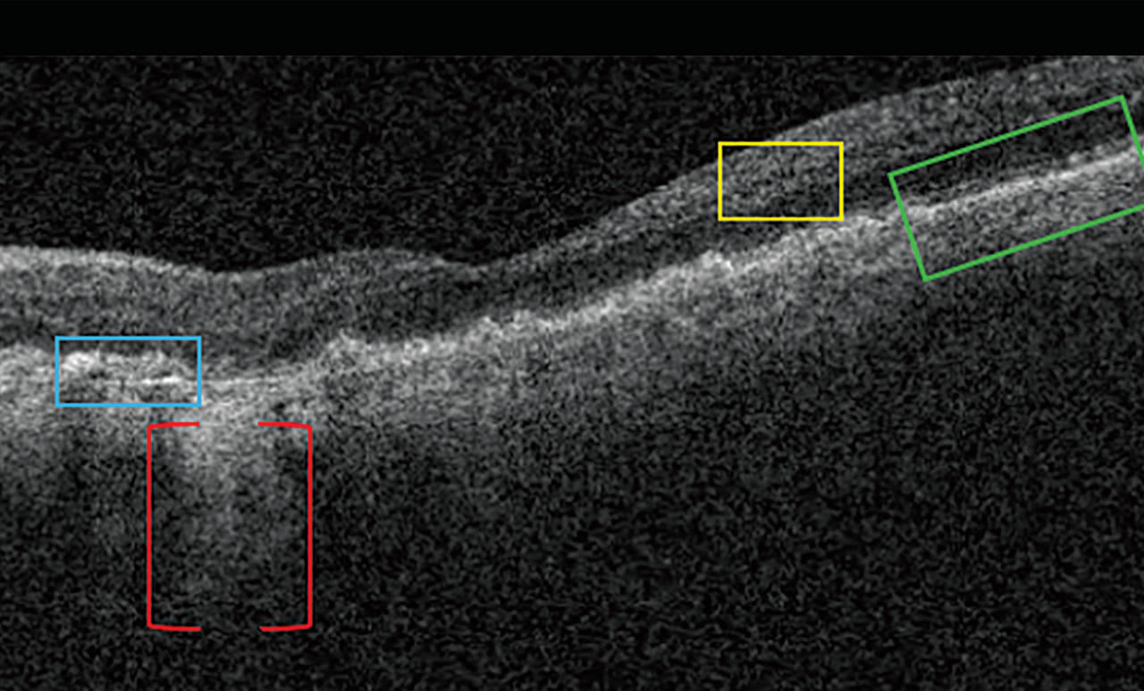 Figure 2. Note this OCT image showing iRORA characteristics. Blue Box: drusen with hyporeflective core; heterogeneous internal reflectivity within drusen (HIRD). Red Brackets: area of choroidal hypertransmission (hyperTD). Yellow Box: subsidence of INL & OPL. Green Box: loss of RPE.