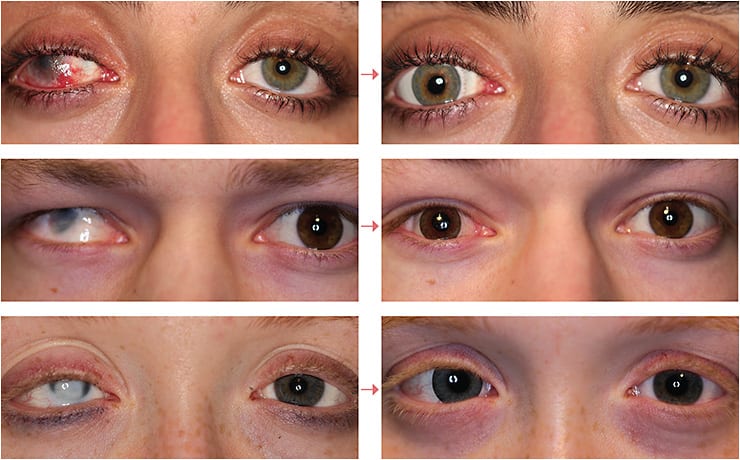 Before and after photos of several patients who sought Dr. Cassel to improve the appearance of their eyes.
Images courtesy of Mitch Cassel, O.D.