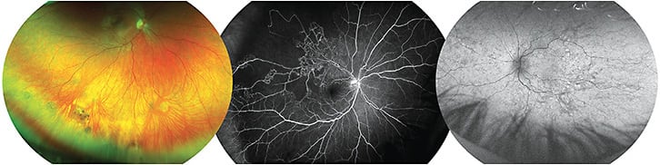 Widefield imaging of (left) atrophic holes with surrounding subretinal fluid with photography and OCT, (middle) FA of peripheral vascular non-perfusion from a branch retinal vein occlusion, and (right) diffuse mid-peripheral RPE alterations on the FAF of a female carrier of choroideremia. Image courtesy of Dr. Hayns.