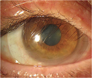 Figure 1. Scleral lenses can protect the corneal surface from the lids and lashes. Photo courtesy of Dr. Gregory W. DeNaeyer.