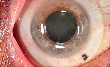 Scleral lens over eye that underwent RK surgery. 
Image courtesy of Dr. Edward Boshnick