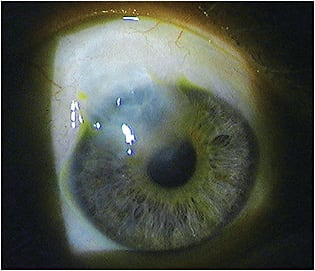 Pictured is a filtering bleb with creep onto the cornea. 
Image courtesy of Dr. Justin Schweitzer