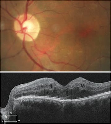 SD-OCT reveals diabetic retinopathy with diabetic macular edema, with an increase in retinal thickness, multiple hyperreflective retinal foci, intraretinal cystoid spaces, and outer retinal layers disruption.Images are courtesy of Dr. Sherrol Reynolds.