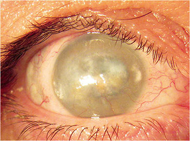 Figure 1. Corneal scarring OD. Image courtesy of Dr. Gregory W. DeNaeyer.