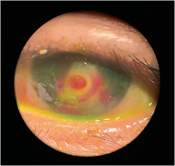 Perforated cornea related to neurotrophic keratitis. Photo courtesy of Dr. Koetting.