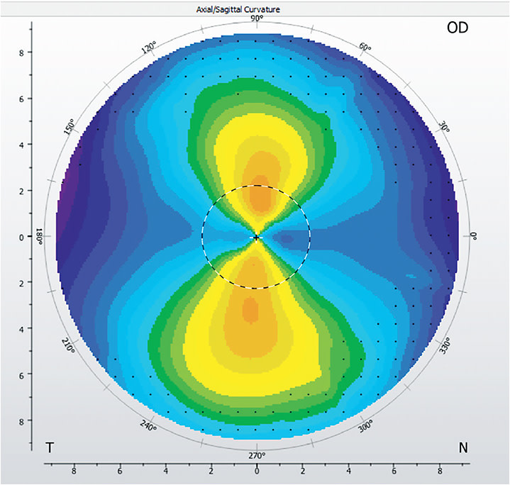 Topography on a healthy eye with astigmatism.
Images courtesy of Dr. Andrew Fischer