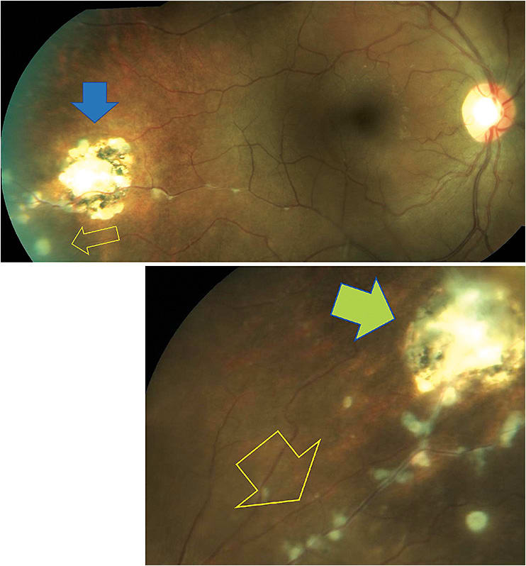 Figure 1. Note this patient with a known history of sarcoidosis and recent elevation of angiotensin-converting enzyme (ACE) during pregnancy. She presented with sudden vision changes and eye pain. In addition to signs of iritis, her posterior segment findings included old sarcoid granulomas in the inferotemporal (blue arrow) and superonasal (green arrow) that appeared partially active. Also, retinal vasculitis, evident by what is known as “candle wax dripping,” was seen in these sectors (yellow arrows).Images courtesy of Dr. Attar and Dr. Rafieetary